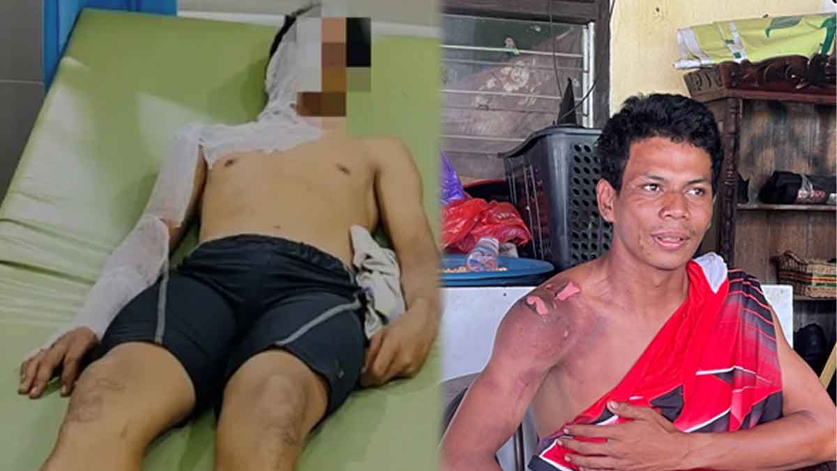 Anggota relawan BPK PKCM Maulana Adi Saputra yang mengalami luka bakar, ditemui di kediamannya Jalan Tjilik Riwut Km 3,5.